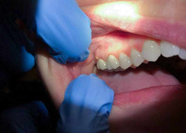 Best Emergency Gum Treatment in Fenton, MO