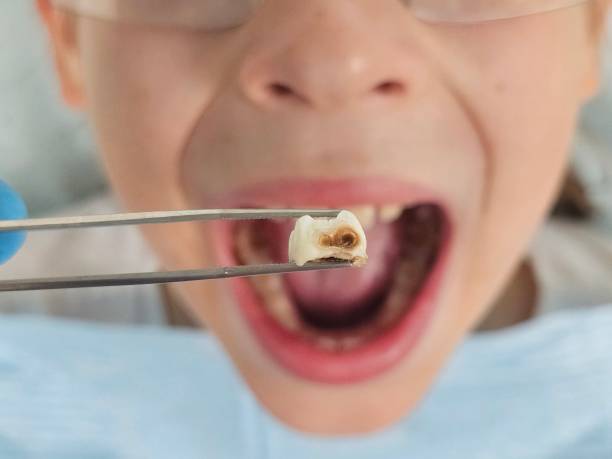 Best Emergency Root Canal Treatment in Fenton, MO